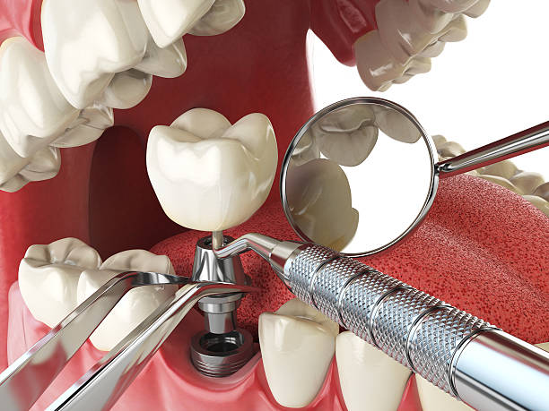 Best Emergency Root Canal Treatment in Sundown, TX